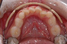 affollamento dentale, estrazioni